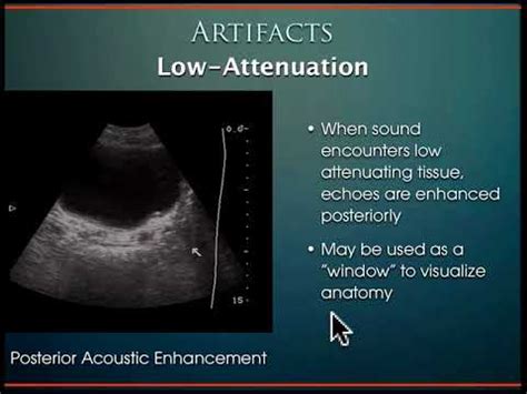kub ultrasound normal results